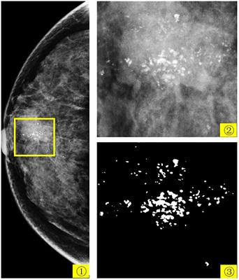 A novel approach for segmentation and quantitative analysis of breast calcification in mammograms